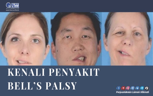 Kenali Penyakit Bell's Palsy